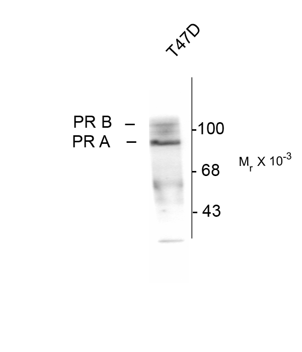 PR / Progesterone Receptor Antibody - Western blot of human T47D cell lysate in the presence of the synthetic progestin agonist R5020 (500 nM) showing specific immunolabeling of the ~90k PR-A isoform and the ~120 PR-B isoform of the progesterone receptor phosphorylated at Ser190. The immunolabeling is specifically blocked by the phosphopeptide used as the antigen (not shown).