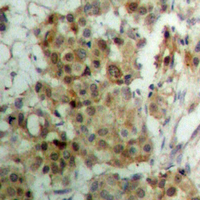 PR / Progesterone Receptor Antibody - Immunohistochemical analysis of Progesterone Receptor (pS190) staining in human breast cancer formalin fixed paraffin embedded tissue section. The section was pre-treated using heat mediated antigen retrieval with sodium citrate buffer (pH 6.0). The section was then incubated with the antibody at room temperature and detected using an HRP conjugated compact polymer system. DAB was used as the chromogen. The section was then counterstained with hematoxylin and mounted with DPX.