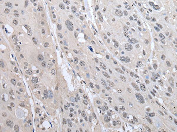 PRAME Antibody - Immunohistochemistry of paraffin-embedded Human esophagus cancer tissue  using PRAME Polyclonal Antibody at dilution of 1:65(×200)