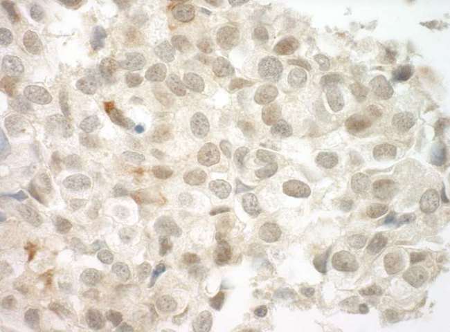 PRCC / RCCP1 Antibody - Detection of Human PRCC by Immunohistochemistry. Sample: FFPE section of human breast carcinoma. Antibody: Affinity purified rabbit anti-PRCC used at a dilution of 1:250.