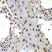 PRDM14 Antibody - Immunohistochemistry of paraffin-embedded human well-differentiated squamous skin carcinoma tissue.