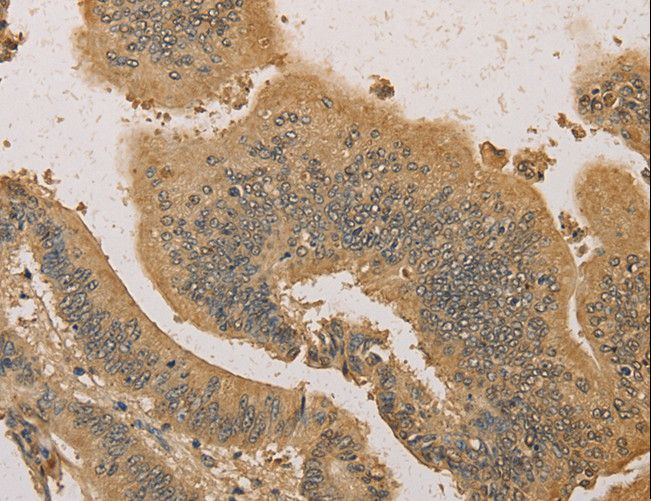 PRDM14 Antibody - Immunohistochemistry of paraffin-embedded Human colon cancer using PRDM14 Polyclonal Antibody at dilution of 1:30.