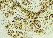PRDM14 Antibody - 1:100 staining human breast carcinoma tissue by IHC-P. The sample was formaldehyde fixed and a heat mediated antigen retrieval step in citrate buffer was performed. The sample was then blocked and incubated with the antibody for 1.5 hours at 22°C. An HRP conjugated goat anti-rabbit antibody was used as the secondary.