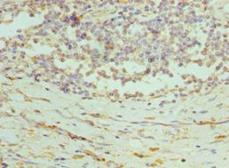 PRDX1 / Peroxiredoxin 1 Antibody - Immunohistochemistry of paraffin-embedded human rectal cancer using antibody at 1:100 dilution.