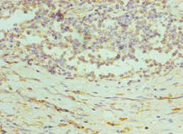 PRDX1 / Peroxiredoxin 1 Antibody - Immunohistochemistry of paraffin-embedded human colon cancer using PRDX1 Antibody at dilution of 1:100