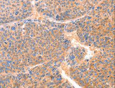PRDX2 / Peroxiredoxin 2 Antibody - Immunohistochemistry of paraffin-embedded Human liver cancer using PRDX2 Polyclonal Antibody at dilution of 1:80.
