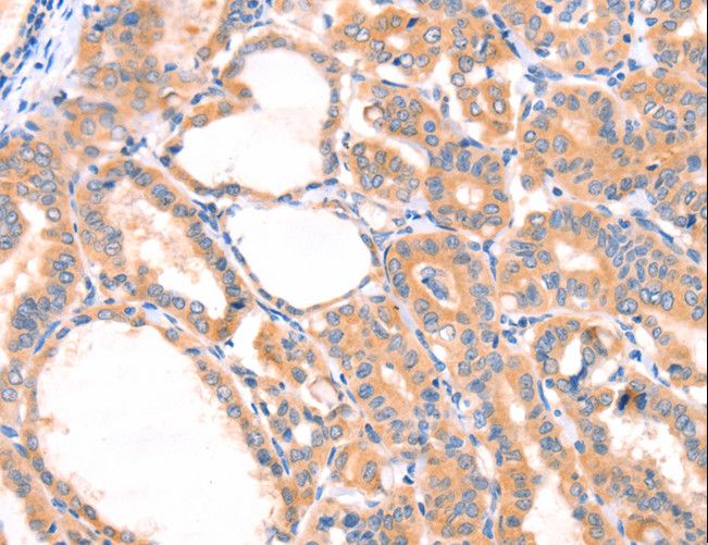 PRDX2 / Peroxiredoxin 2 Antibody - Immunohistochemistry of paraffin-embedded Human thyroid cancer using PRDX2 Polyclonal Antibody at dilution of 1:80.