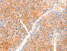 PRDX2 / Peroxiredoxin 2 Antibody - Immunohistochemistry of paraffin-embedded Human liver cancer using PRDX2 Polyclonal Antibody at dilution of 1:80.