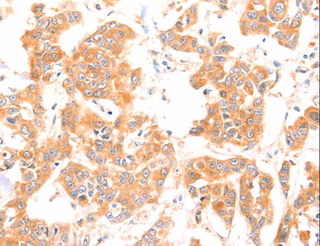 PRDX2 / Peroxiredoxin 2 Antibody - Immunohistochemistry of paraffin-embedded Human breast cancer using PRDX2 Polyclonal Antibody at dilution of 1:80.