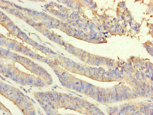 PRDX2 / Peroxiredoxin 2 Antibody - Immunohistochemistry of paraffin-embedded human endometrial cancer at dilution of 1:100