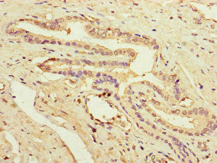 PRDX2 / Peroxiredoxin 2 Antibody - Immunohistochemistry of paraffin-embedded human prostate cancer at dilution of 1:100