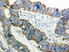 PRDX3 / Peroxiredoxin 3 Antibody - Peroxiredoxin 3 antibody IHC-paraffin: Human Intestinal Cancer Tissue.