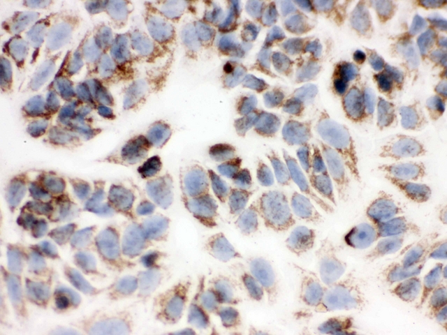 PRDX3 / Peroxiredoxin 3 Antibody - IHC analysis of Peroxiredoxin 3 using anti-Peroxiredoxin 3 antibody. Peroxiredoxin 3 was detected in immunocytochemical section of MCF-7 cell. Heat mediated antigen retrieval was performed in citrate buffer (pH6, epitope retrieval solution) for 20 mins. The tissue section was blocked with 10% goat serum. The tissue section was then incubated with 1µg/ml rabbit anti-Peroxiredoxin 3 Antibody overnight at 4°C. Biotinylated goat anti-rabbit IgG was used as secondary antibody and incubated for 30 minutes at 37°C. The tissue section was developed using Strepavidin-Biotin-Complex (SABC) with DAB as the chromogen.