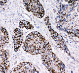 PRDX3 / Peroxiredoxin 3 Antibody - PRDX3 / Peroxiredoxin 3 antibody. IHC(P): Human Lung Cancer Tissue.