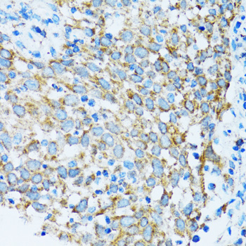 PRDX3 / Peroxiredoxin 3 Antibody - Immunohistochemistry of paraffin-embedded human lung cancer tissue.