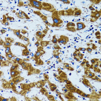 PRDX3 / Peroxiredoxin 3 Antibody - Immunohistochemistry of paraffin-embedded human liver cancer tissue.