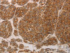 PRDX3 / Peroxiredoxin 3 Antibody - Immunohistochemistry of paraffin-embedded Human liver cancer using PRDX3 Polyclonal Antibody at dilution of 1:50.