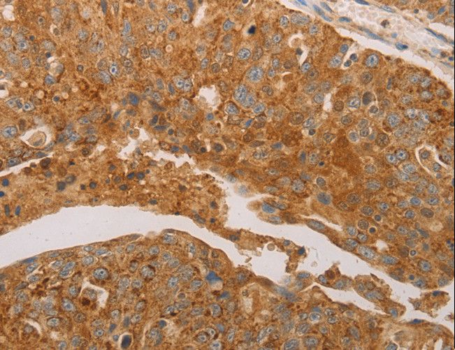 PRDX3 / Peroxiredoxin 3 Antibody - Immunohistochemistry of paraffin-embedded Human ovarian cancer using PRDX3 Polyclonal Antibody at dilution of 1:50.