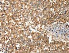 PRDX3 / Peroxiredoxin 3 Antibody - Immunohistochemistry of paraffin-embedded Human breast cancer using PRDX3 Polyclonal Antibody at dilution of 1:50.