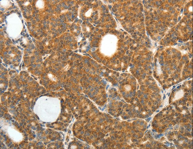 PRDX3 / Peroxiredoxin 3 Antibody - Immunohistochemistry of paraffin-embedded Human thyroid cancer using PRDX3 Polyclonal Antibody at dilution of 1:50.