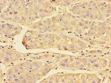 PRDX3 / Peroxiredoxin 3 Antibody - Immunohistochemistry of paraffin-embedded human liver cancer tissue tissue using PRDX3 Antibody at dilution of 1:100