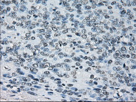 PRDX4 / Peroxiredoxin 4 Antibody - IHC of paraffin-embedded Carcinoma of Human bladder tissue using anti-PRDX4 mouse monoclonal antibody.