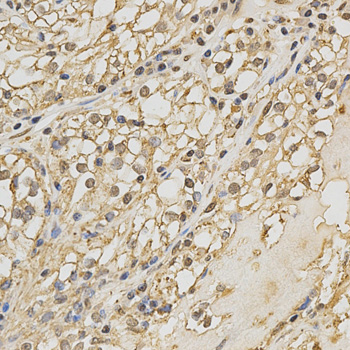 PRDX4 / Peroxiredoxin 4 Antibody - Immunohistochemistry of paraffin-embedded human kidney cancer tissue.