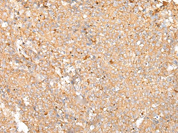 PRDX4 / Peroxiredoxin 4 Antibody - Immunohistochemistry of paraffin-embedded Human cervical cancer tissue  using PRDX4 Polyclonal Antibody at dilution of 1:25(×200)