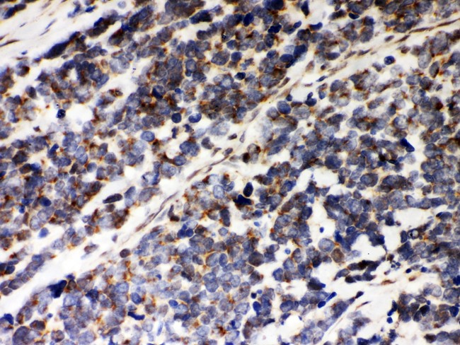 PRDX5 / Peroxiredoxin 5 Antibody - Peroxiredoxin 5 antibody IHC-paraffin: Human Lung Cancer Tissue.