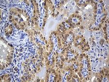 PRDX5 / Peroxiredoxin 5 Antibody - Immunohistochemical staining of paraffin-embedded Carcinoma of Human thyroid tissue using anti-PRDX5 mouse monoclonal antibody. (Heat-induced epitope retrieval by 1mM EDTA in 10mM Tris buffer. (pH8.5) at 120°C for 3 min. (1:150)