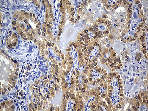 PRDX5 / Peroxiredoxin 5 Antibody - Immunohistochemical staining of paraffin-embedded Carcinoma of Human thyroid tissue using anti-PRDX5 mouse monoclonal antibody. (Heat-induced epitope retrieval by 1mM EDTA in 10mM Tris buffer. (pH8.5) at 120°C for 3 min. (1:150)