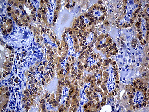 PRDX5 / Peroxiredoxin 5 Antibody - Immunohistochemical staining of paraffin-embedded Carcinoma of Human thyroid tissue using anti-PRDX5 mouse monoclonal antibody. (Heat-induced epitope retrieval by 1mM EDTA in 10mM Tris buffer. (pH8.5) at 120°C for 3 min. (1:150)