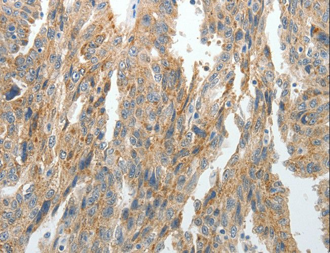 PRDX5 / Peroxiredoxin 5 Antibody - Immunohistochemistry of paraffin-embedded Human ovarian cancer using PRDX5 Polyclonal Antibody at dilution of 1:40.