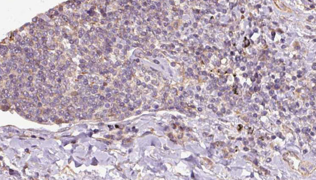 PRDX5 / Peroxiredoxin 5 Antibody - 1:100 staining human lymph carcinoma tissue by IHC-P. The sample was formaldehyde fixed and a heat mediated antigen retrieval step in citrate buffer was performed. The sample was then blocked and incubated with the antibody for 1.5 hours at 22°C. An HRP conjugated goat anti-rabbit antibody was used as the secondary.