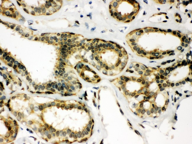 PRDX6 / Peroxiredoxin 6 Antibody - Peroxiredoxin 6 antibody IHC-paraffin. IHC(P): Human Mammary Cancer Tissue.