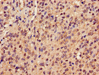 PRDX6 / Peroxiredoxin 6 Antibody - Immunohistochemistry image of paraffin-embedded human glioma cancer at a dilution of 1:100