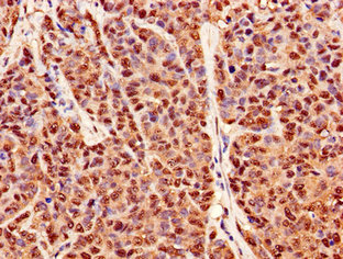 PRDX6 / Peroxiredoxin 6 Antibody - Immunohistochemistry image of paraffin-embedded human ovarian cancer at a dilution of 1:100