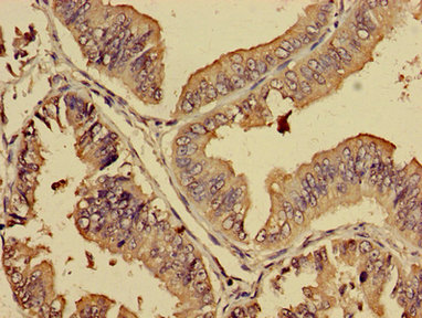 PREB Antibody - Immunohistochemistry image of paraffin-embedded human endometrial cancer at a dilution of 1:100