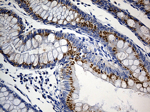 PRELID1 Antibody - Immunohistochemical staining of paraffin-embedded Adenocarcinoma of Human colon tissue using anti-PRELID1 mouse monoclonal antibody. (Heat-induced epitope retrieval by 1mM EDTA in 10mM Tris buffer. (pH8.5) at 120°C for 3 min. (1:500)