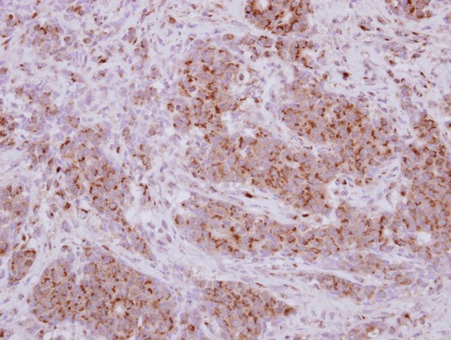 PRELID1 Antibody - IHC of paraffin-embedded Breast ca, using PRELID1 antibody at 1:250 dilution.