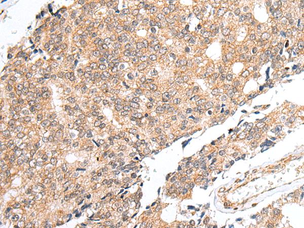 PRELID1 Antibody - Immunohistochemistry of paraffin-embedded Human prost at e cancer tissue  using PRELID1 Polyclonal Antibody at dilution of 1:40(×200)