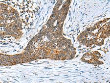 PREPL Antibody - Immunohistochemistry of paraffin-embedded Human esophagus cancer tissue  using PREPL Polyclonal Antibody at dilution of 1:55(×200)
