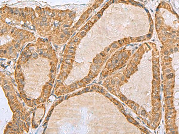 PREPL Antibody - Immunohistochemistry of paraffin-embedded Human thyroid cancer tissue  using PREPL Polyclonal Antibody at dilution of 1:55(×200)