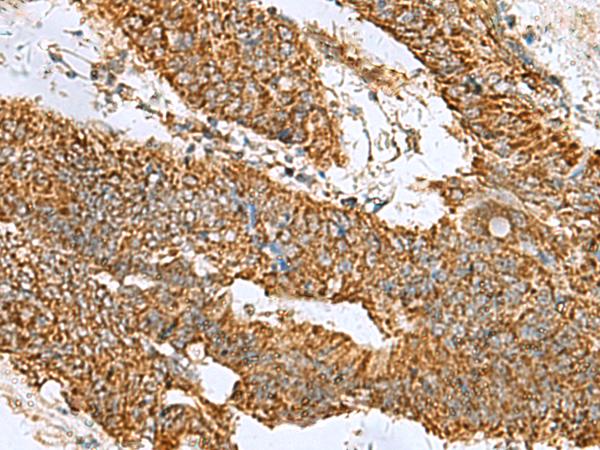 PREPL Antibody - Immunohistochemistry of paraffin-embedded Human colorectal cancer tissue  using PREPL Polyclonal Antibody at dilution of 1:60(×200)