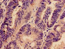 PREX1 / P-REX1 Antibody - Immunohistochemistry analysis of human colon cancer at a dilution of 1:100