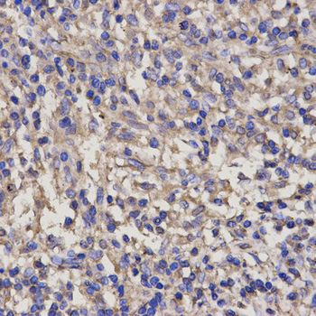 PRF1 / Perforin Antibody - Immunohistochemistry of paraffin-embedded human lung cancer using PRF1 antibody at dilution of 1:200 (x400 lens).