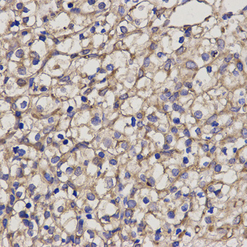 PRF1 / Perforin Antibody - Immunohistochemistry of paraffin-embedded human kidney cancer using PRF1 antibody at dilution of 1:200 (x400 lens).