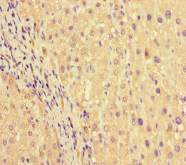 PRG2 / Proteoglycan 2 Antibody - Immunohistochemistry of paraffin-embedded human liver cancer at dilution of 1:100