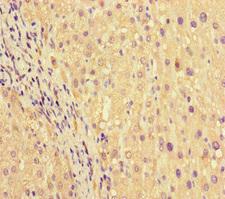 PRG2 / Proteoglycan 2 Antibody - Immunohistochemistry of paraffin-embedded human liver cancer at dilution of 1:100