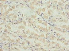 PRICKLE2 Antibody - Immunohistochemistry of paraffin-embedded human gastric cancer at dilution 1:100